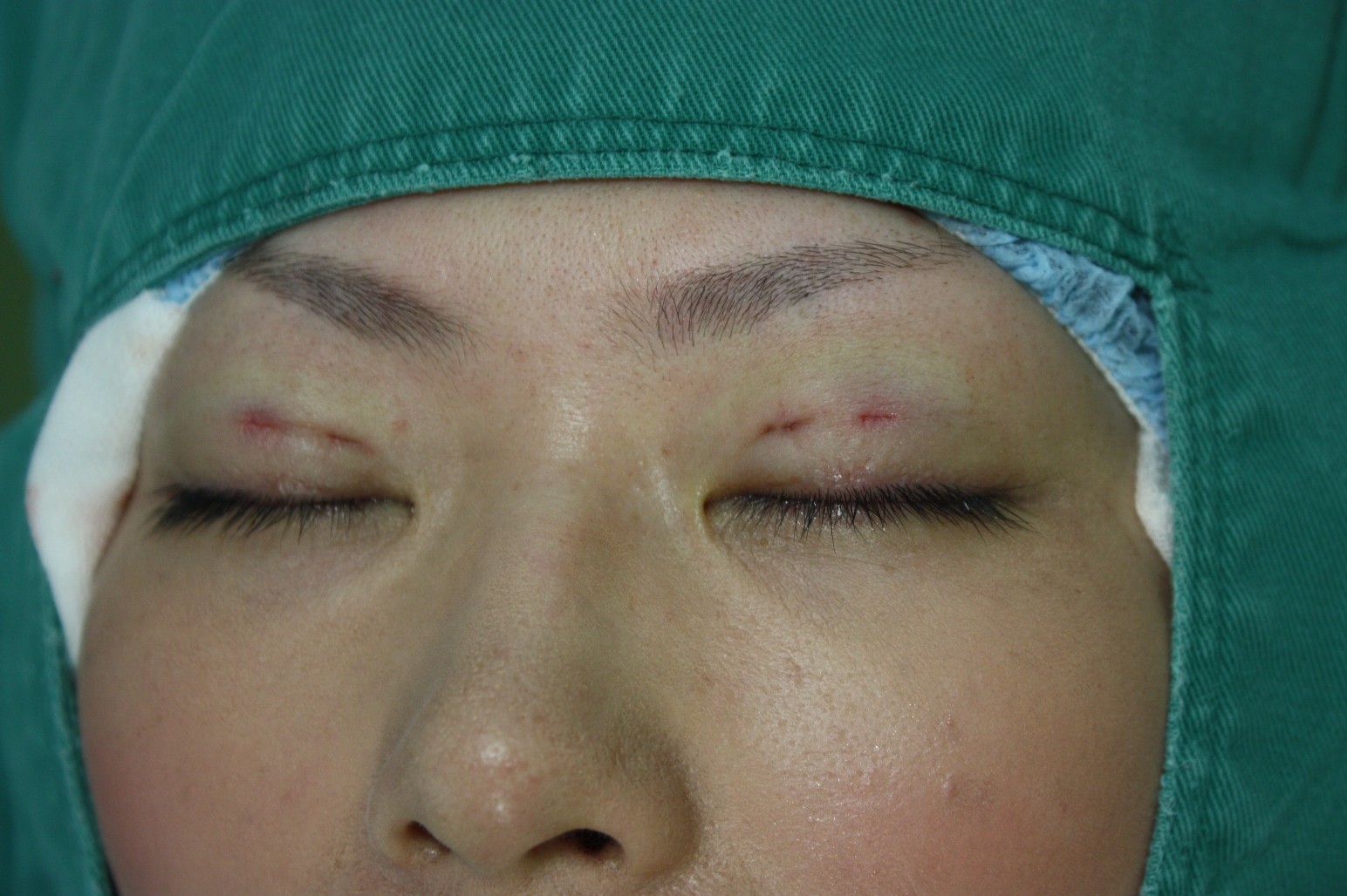double eyelid suturing technique4