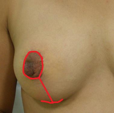 乳房挙上手術痕