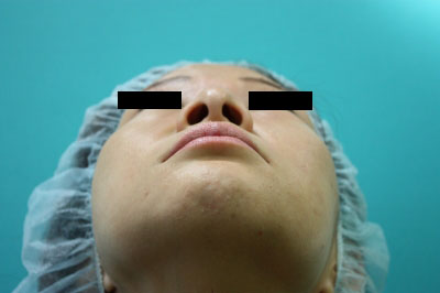 小鼻縮小手術前2