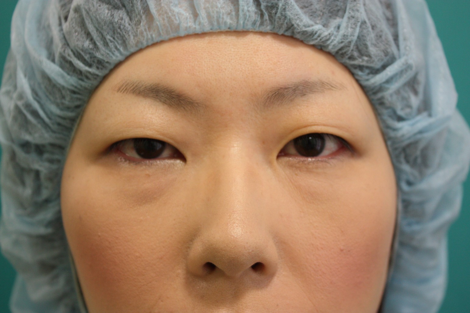  double eyelid suturing technique 1