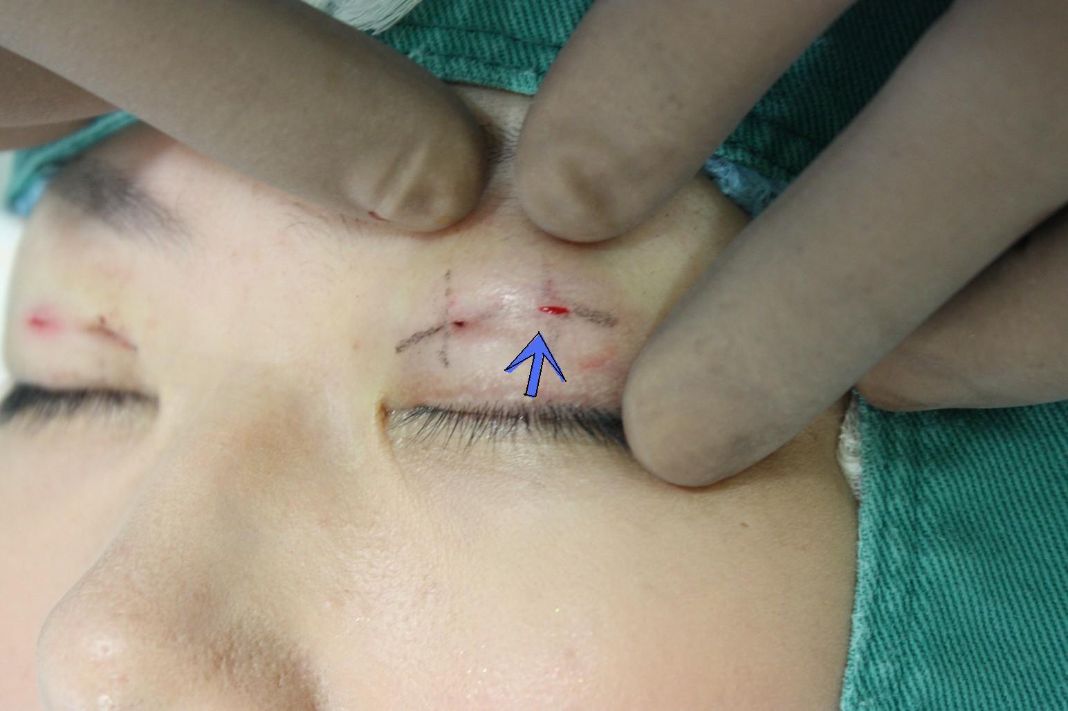 double eyelid suturing technique2