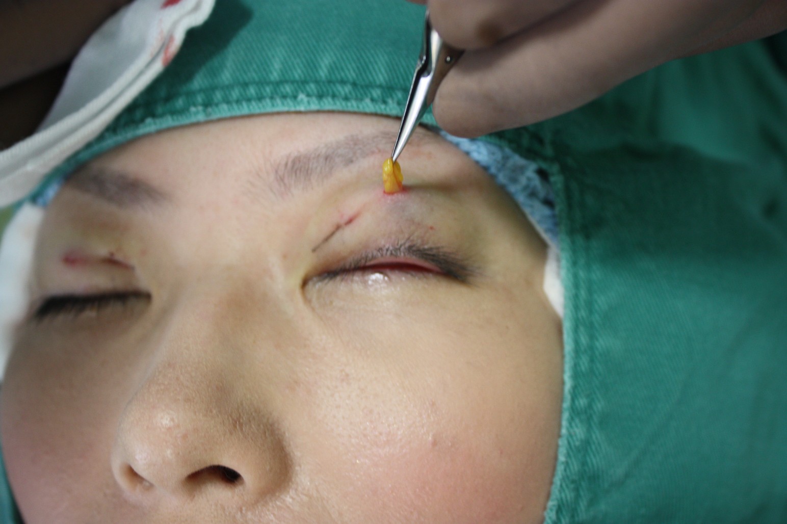 double eyelid suturing technique3
