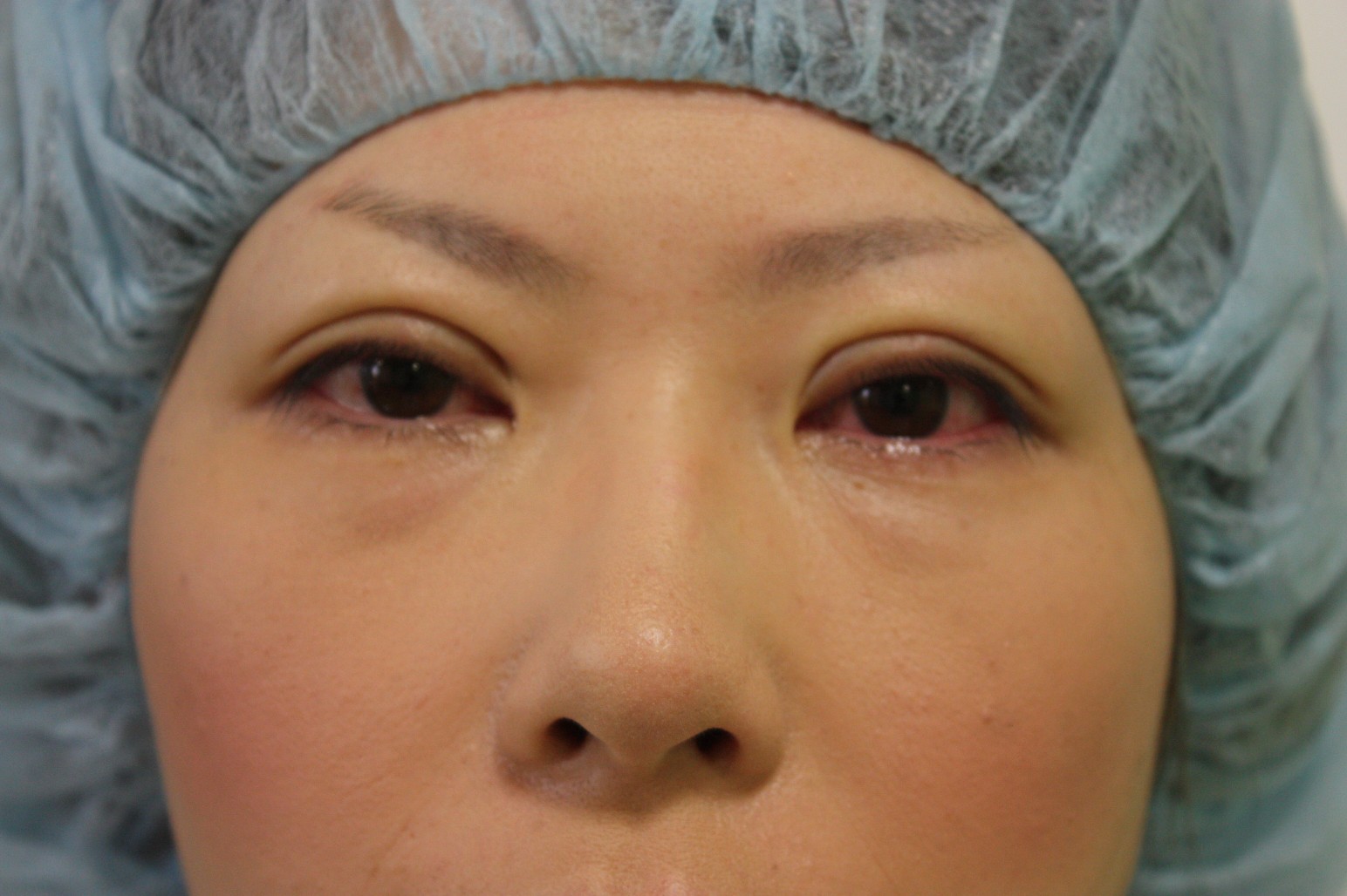 double eyelid suturing technique5