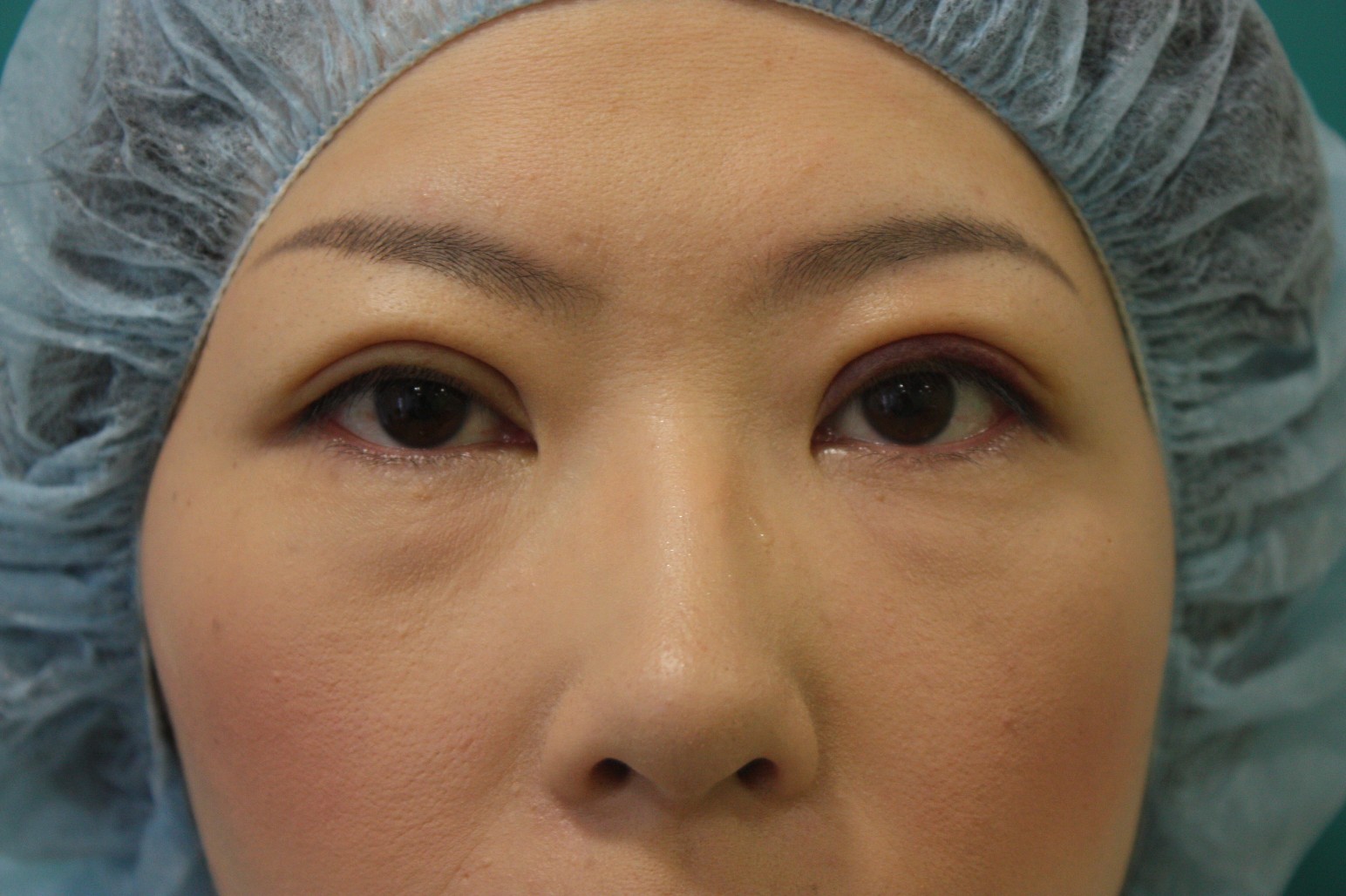 double eyelid suturing technique6