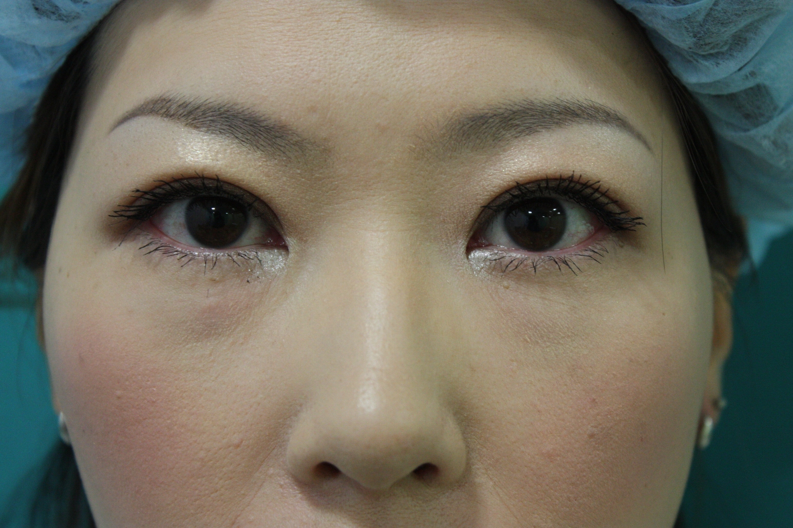 double eyelid suturing technique7