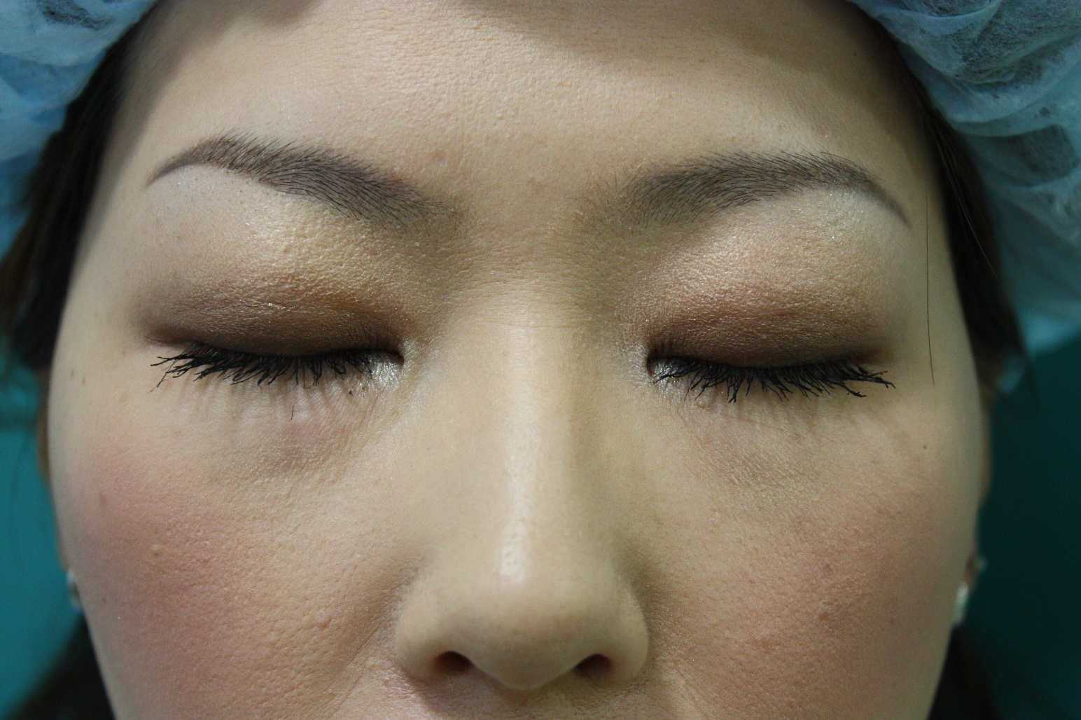 double eyelid suturing technique8