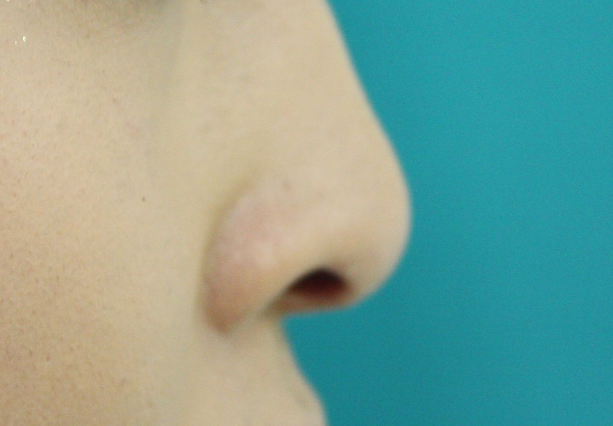 鼻プロテーゼ後2