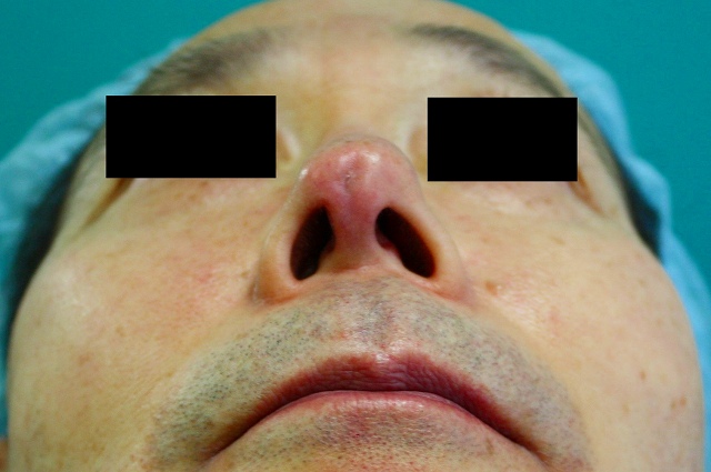 鼻プロテーゼ修正後5M2