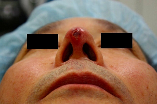 鼻プロテーゼ修正前2