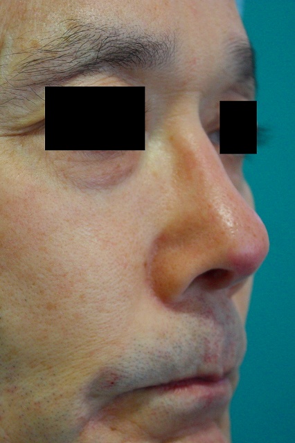 鼻プロテーゼ修正後右斜