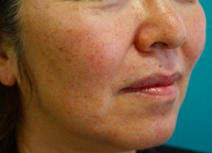 Ultherapy after