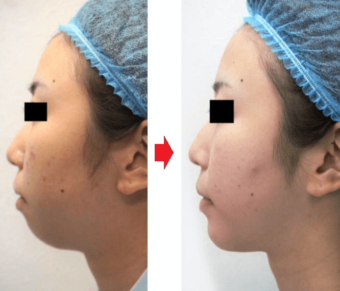 【顎プロテーゼ手術の全貌】メリットとダウンタイム等について